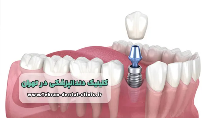 بهترین کلینیک دندان پزشکی در تهران برای ایمپلنت